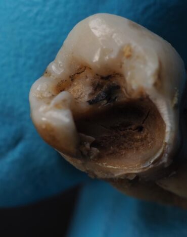 Diş çürüğünün oluşum sürecini ve bu süreçte etkili olan günlük alışkanlıkları gösteren görsel.