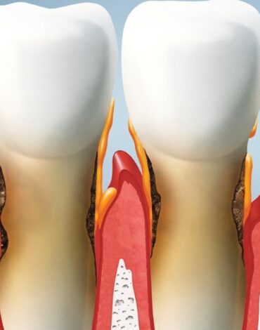 Diş eti çekilmesine neden olan etkenleri gösteren ağız sağlığı görseli.