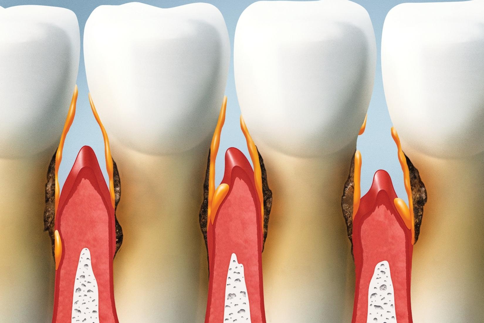 Diş eti çekilmesine neden olan etkenleri gösteren ağız sağlığı görseli.