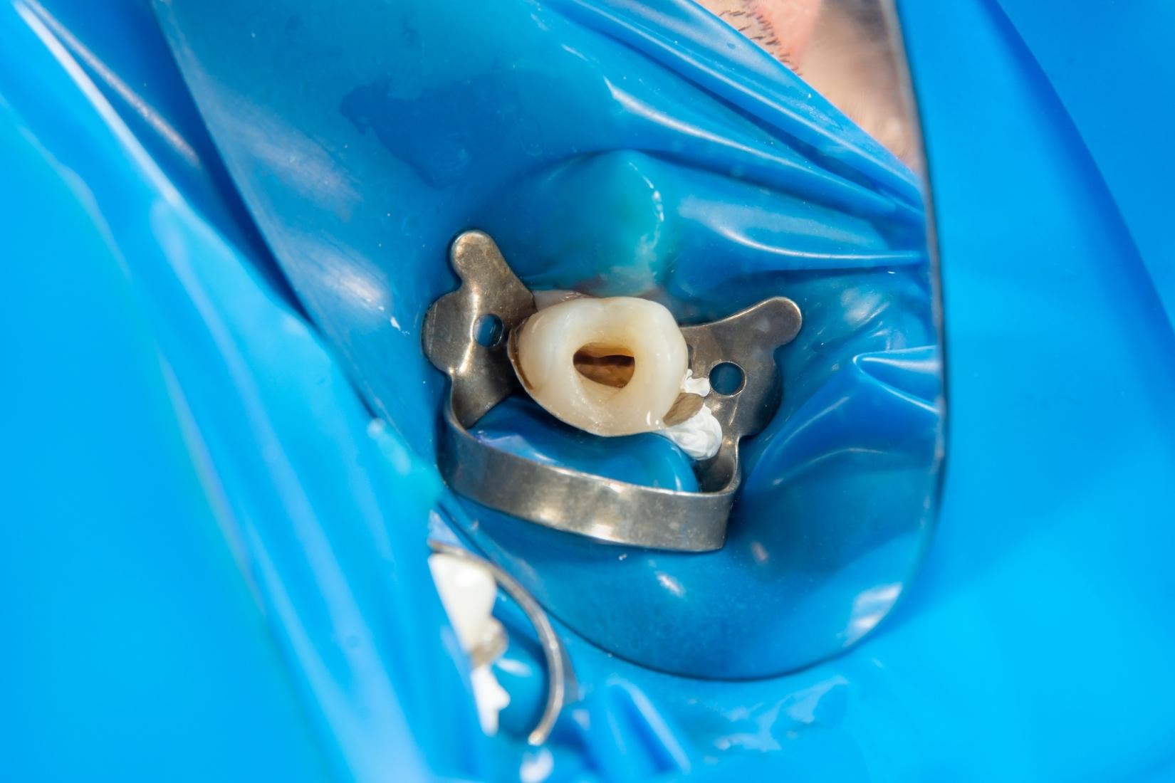 Kanal tedavisinin aşamalarını ve uygulama gerektiren durumları gösteren diş sağlığı görseli.