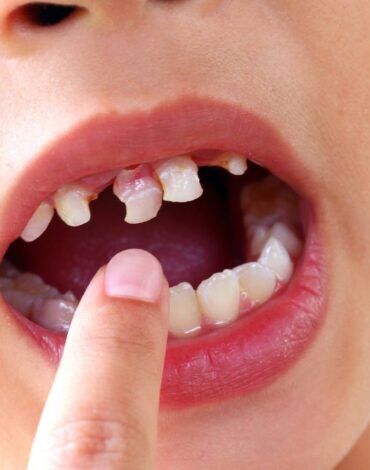 Çocuklarda diş çürüğü oluşumunu etkileyen beslenme alışkanlıkları ve ağız bakım rutinlerini gösteren bilgilendirici görsel.