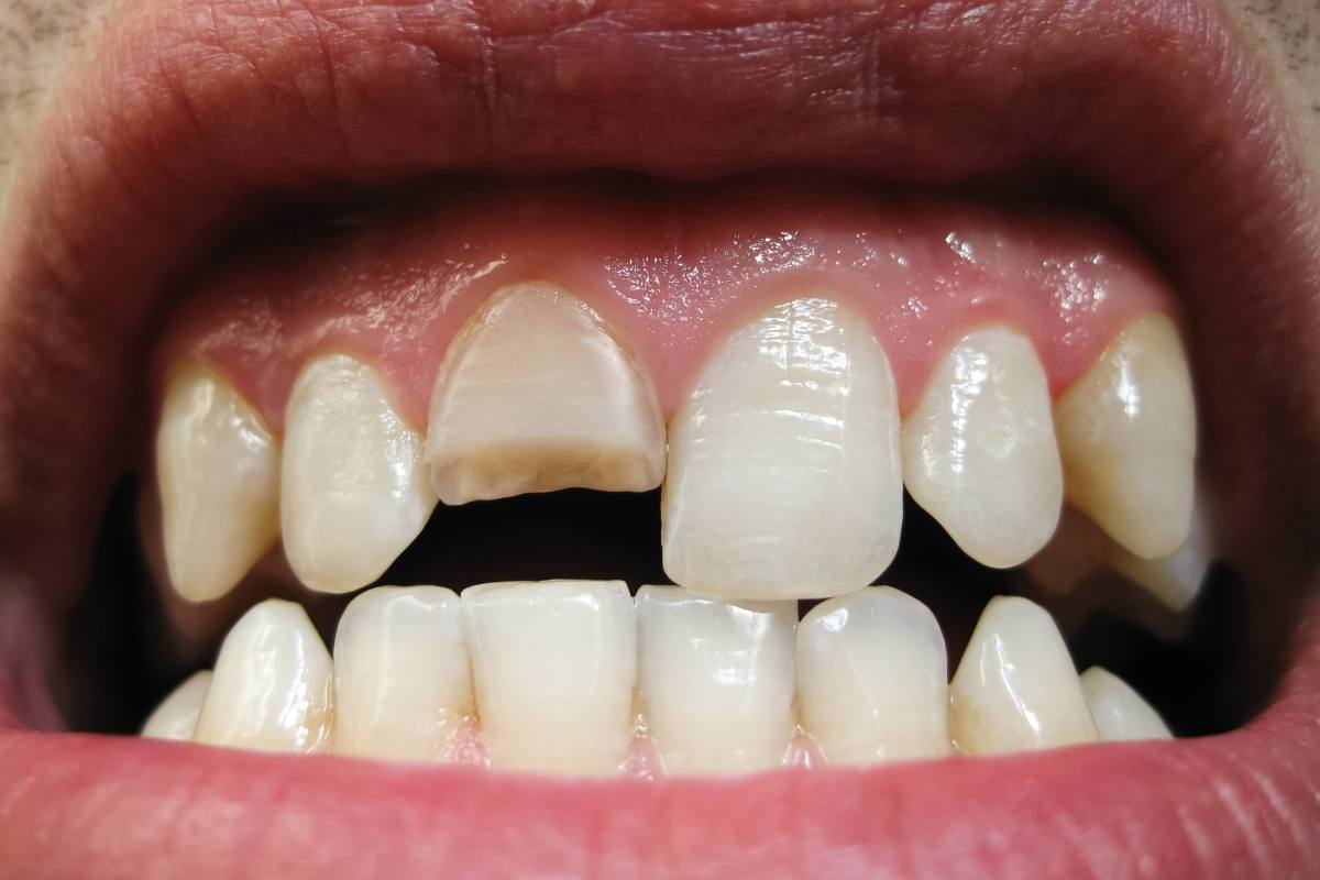 Günlük hayatta diş kırılmalarına yol açan durumları ve korunma yollarını gösteren bilgilendirici görsel.