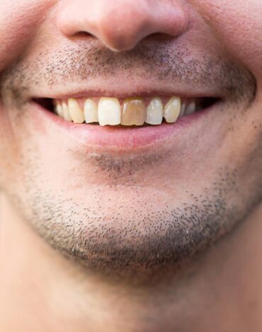 Diş renklenmesine neden olan beslenme ve günlük alışkanlıkları gösteren bilgilendirici görsel.