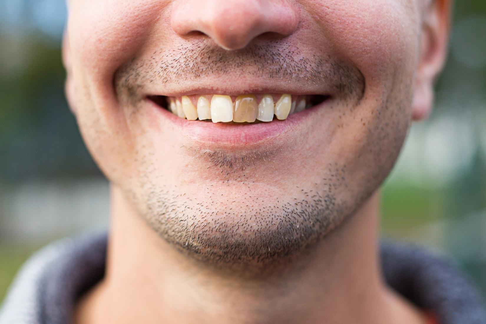 Diş renklenmesine neden olan beslenme ve günlük alışkanlıkları gösteren bilgilendirici görsel.