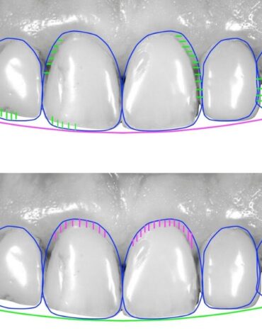 Gülüş estetiğinde diş ve diş eti uyumunu gösteren, yüz ifadesiyle ilişkili bilgilendirici görsel.