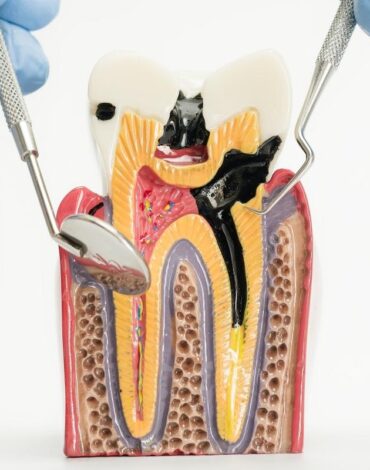 Şeker tüketimi ile diş çürüğü oluşumu arasındaki ilişkiyi ve ağız içindeki süreci gösteren bilgilendirici görsel.