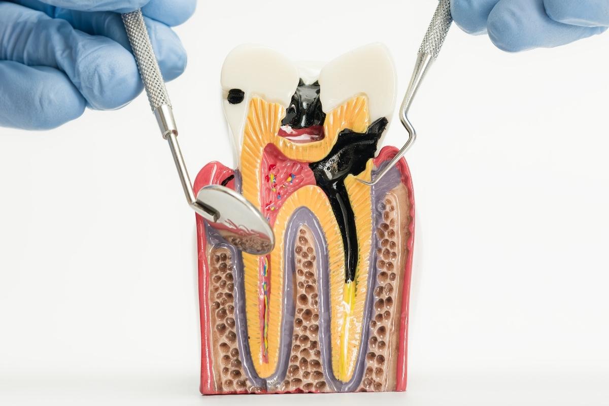 Şeker tüketimi ile diş çürüğü oluşumu arasındaki ilişkiyi ve ağız içindeki süreci gösteren bilgilendirici görsel.