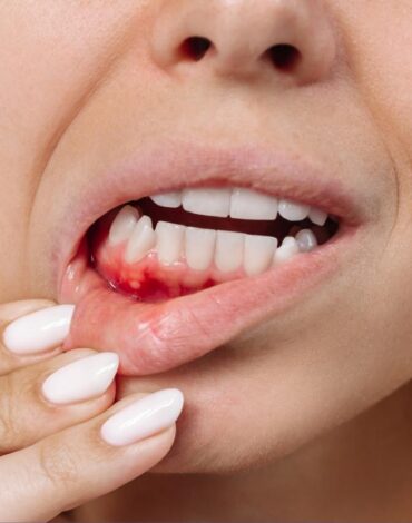 Stresin diş eti dokusu üzerindeki olası etkilerini ve ağız sağlığıyla ilişkisini gösteren bilgilendirici görsel.