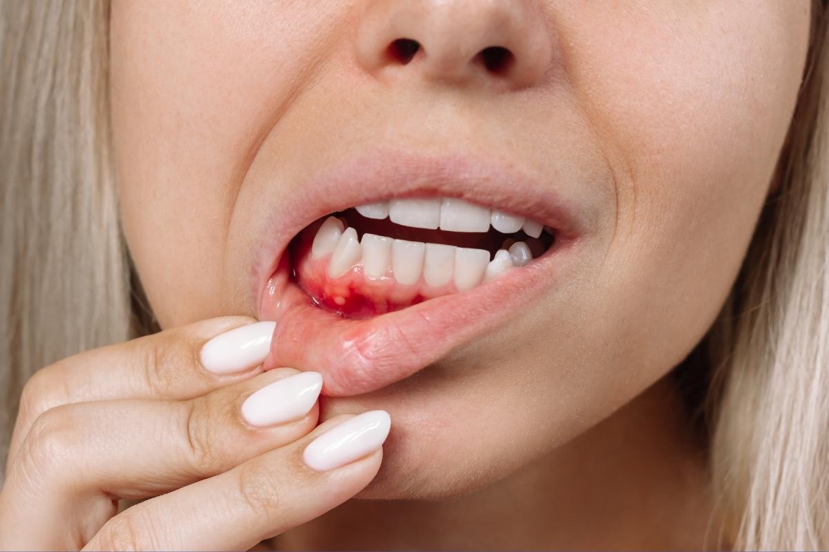 Stresin diş eti dokusu üzerindeki olası etkilerini ve ağız sağlığıyla ilişkisini gösteren bilgilendirici görsel.