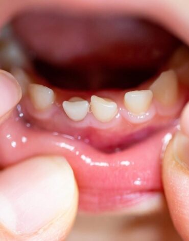 Süt dişlerinin ağız gelişimindeki önemini ve erken kaybın olası etkilerini gösteren bilgilendirici görsel.