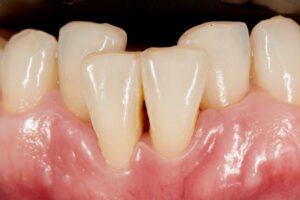 Diş çapraşıklığının oluşum nedenlerini ve çene–diş uyumsuzluğunu gösteren bilgilendirici görsel.