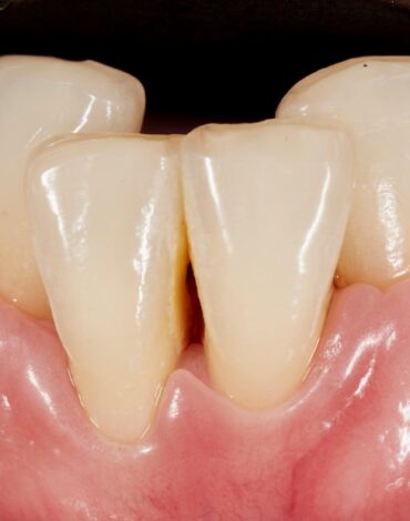 Diş çapraşıklığının oluşum nedenlerini ve çene–diş uyumsuzluğunu gösteren bilgilendirici görsel.