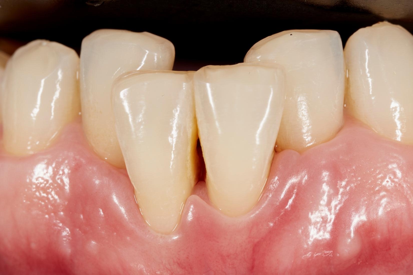 Diş çapraşıklığının oluşum nedenlerini ve çene–diş uyumsuzluğunu gösteren bilgilendirici görsel.