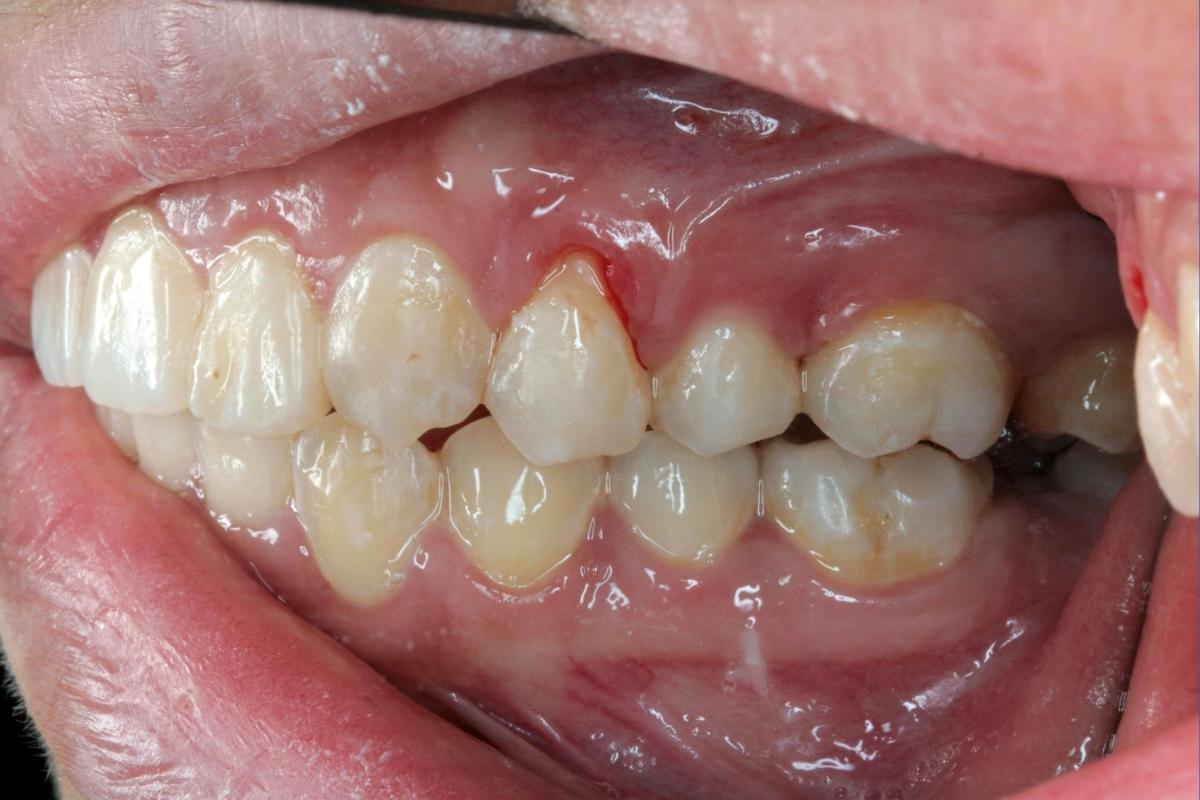 Diş eti kanamasına yol açan faktörleri ve ağız hijyeniyle ilişkisini gösteren bilgilendirici görsel.