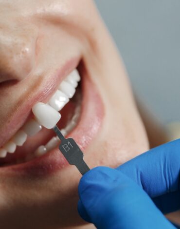 Farklı diş kaplama türlerinin yapısal özelliklerini ve diş üzerindeki konumlarını gösteren bilgilendirici görsel.