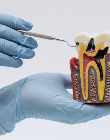 Dişin anatomisini oluşturan mine, dentin ve pulpa tabakalarının konumunu ve görevlerini gösteren bilgilendirici görsel.