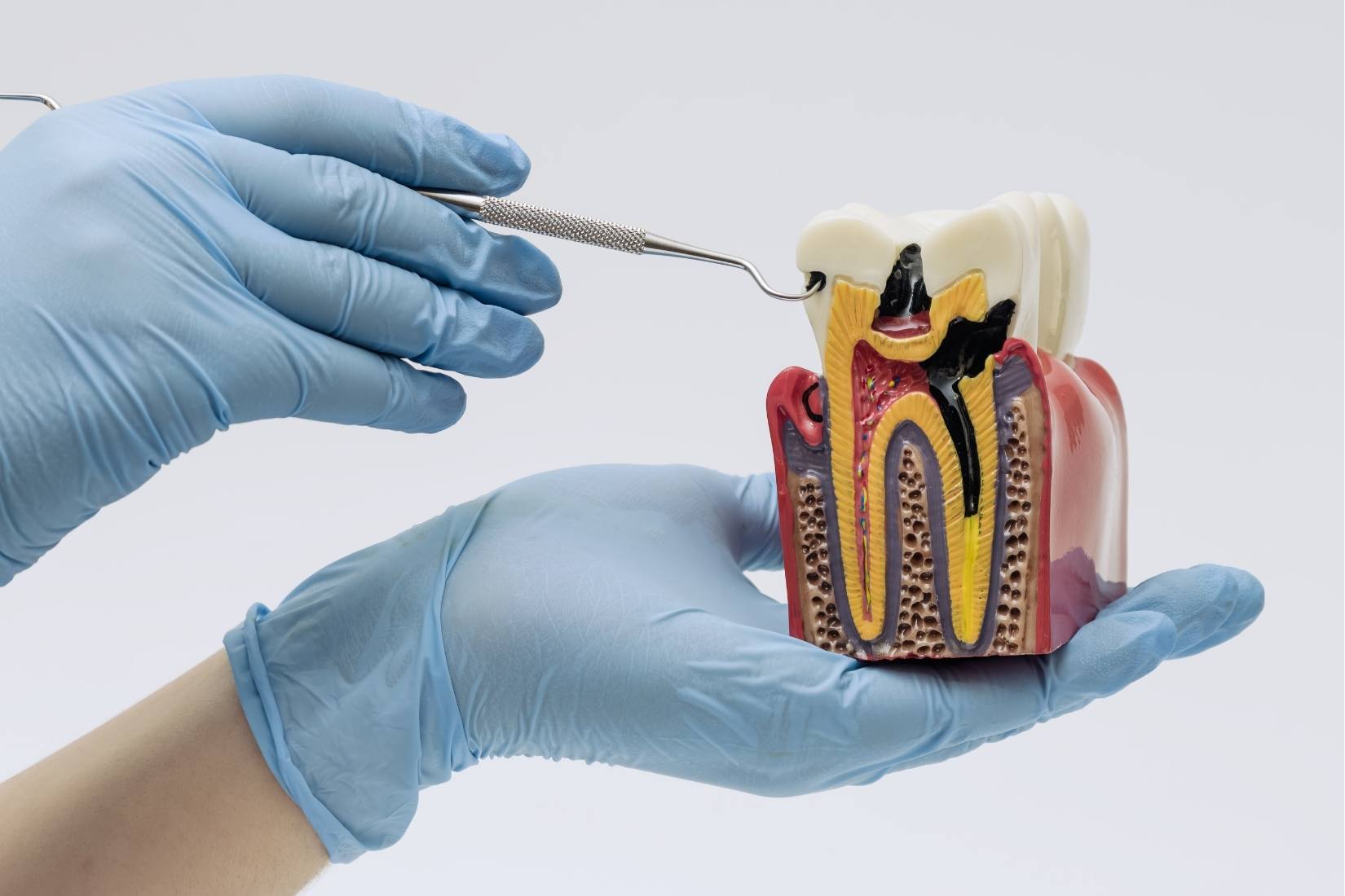 Dişin anatomisini oluşturan mine, dentin ve pulpa tabakalarının konumunu ve görevlerini gösteren bilgilendirici görsel.