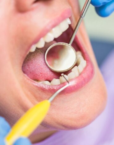 Diş yüzeyinde başlayan çürük oluşumunu ve erken dönem mine değişikliklerini gösteren bilgilendirici görsel.