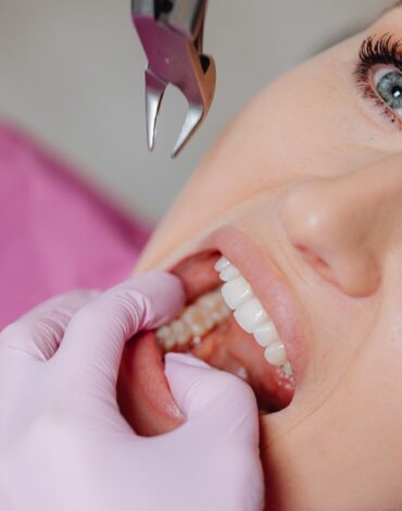 Diş çekimi sonrası oluşan pıhtı ve iyileşme sürecini gösteren bilgilendirici ağız içi görsel.