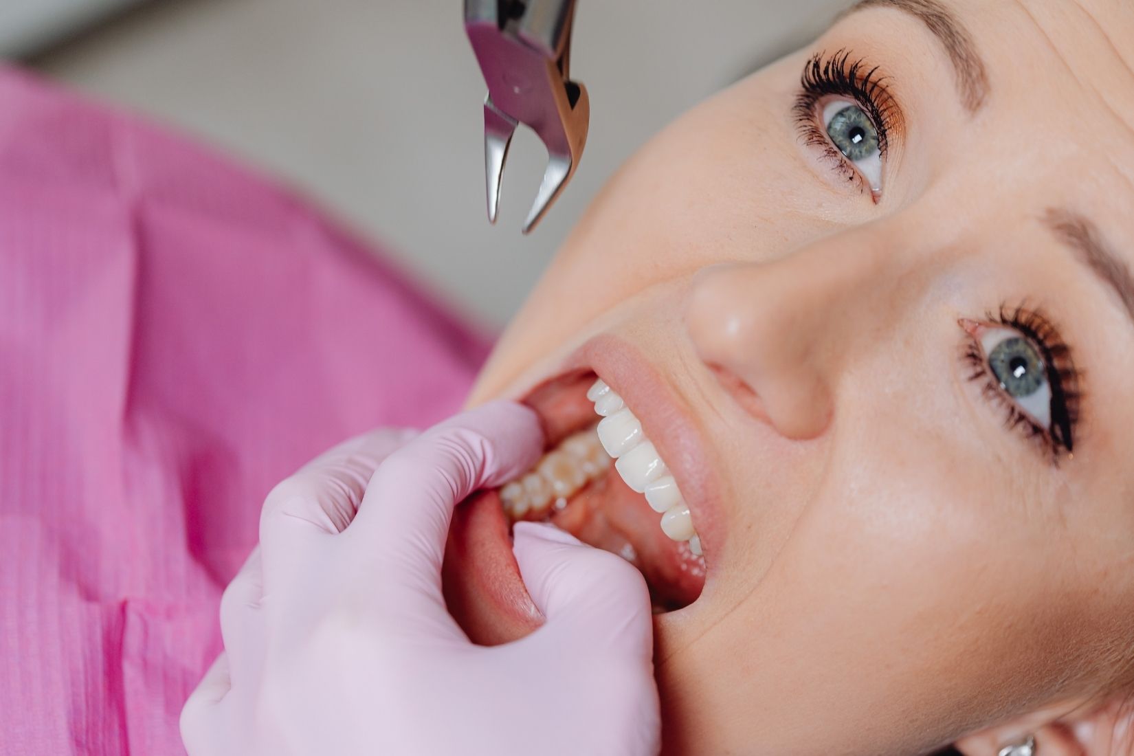 Diş çekimi sonrası oluşan pıhtı ve iyileşme sürecini gösteren bilgilendirici ağız içi görsel.