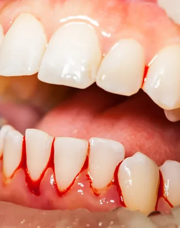 Diş eti kanamasının yaygın nedenlerini ve diş eti sağlığını gösteren bilgilendirici görsel.