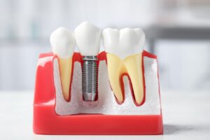 Kemik hacmi azalmış çene bölgesinde implant planlamasını ve kemik grefti uygulamasını gösteren görsel.