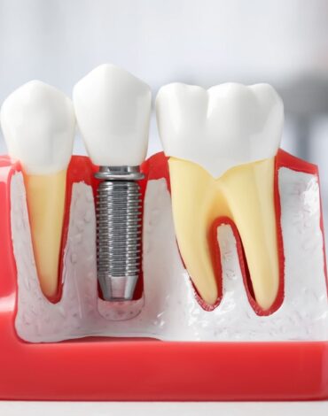 Kemik hacmi azalmış çene bölgesinde implant planlamasını ve kemik grefti uygulamasını gösteren görsel.