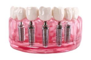 Dental implantın çene kemiği içindeki konumunu ve tedavi planlamasını gösteren bilgilendirici görsel.