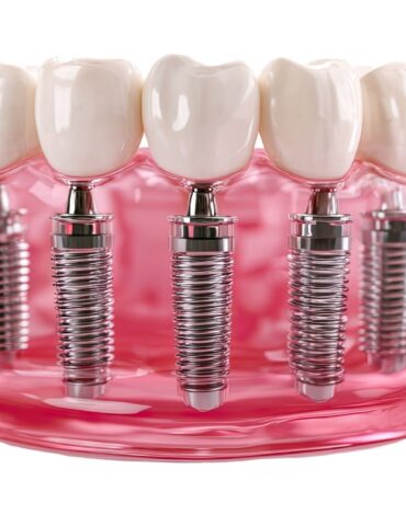 Dental implantın çene kemiği içindeki konumunu ve tedavi planlamasını gösteren bilgilendirici görsel.