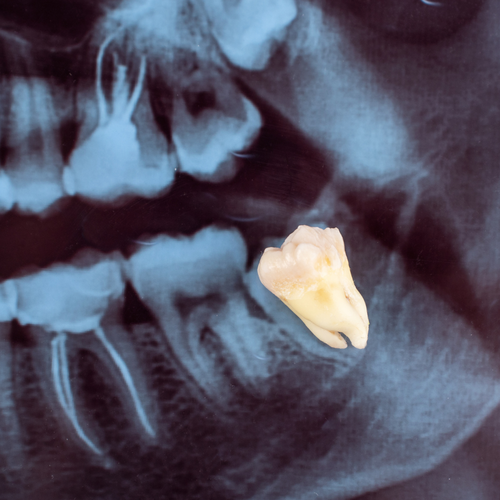 Konya 20'lik diş çekimi sırasında panoramik röntgende gömülü diş görünümü