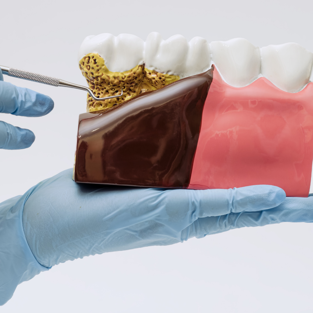 Konya periodontitis tedavisi kapsamında diş eti muayenesi ve periodontal cep ölçümü uygulaması.