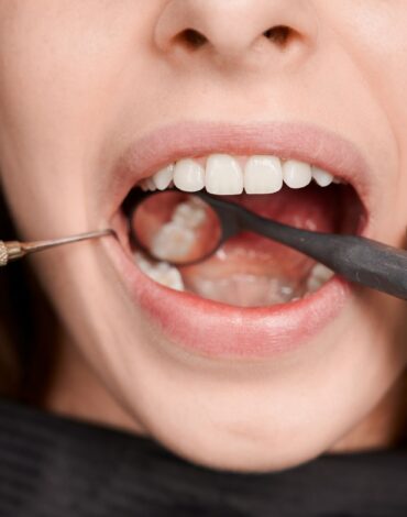 Diş yüzeyinde oluşan diş taşı birikimini ve plak oluşumunu gösteren bilgilendirici dental görsel.