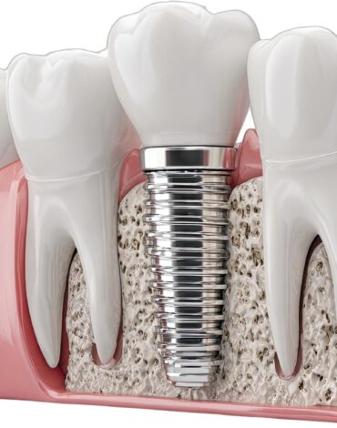Tek diş eksikliğinde implant ve köprü uygulamasını karşılaştıran bilgilendirici dental şema.