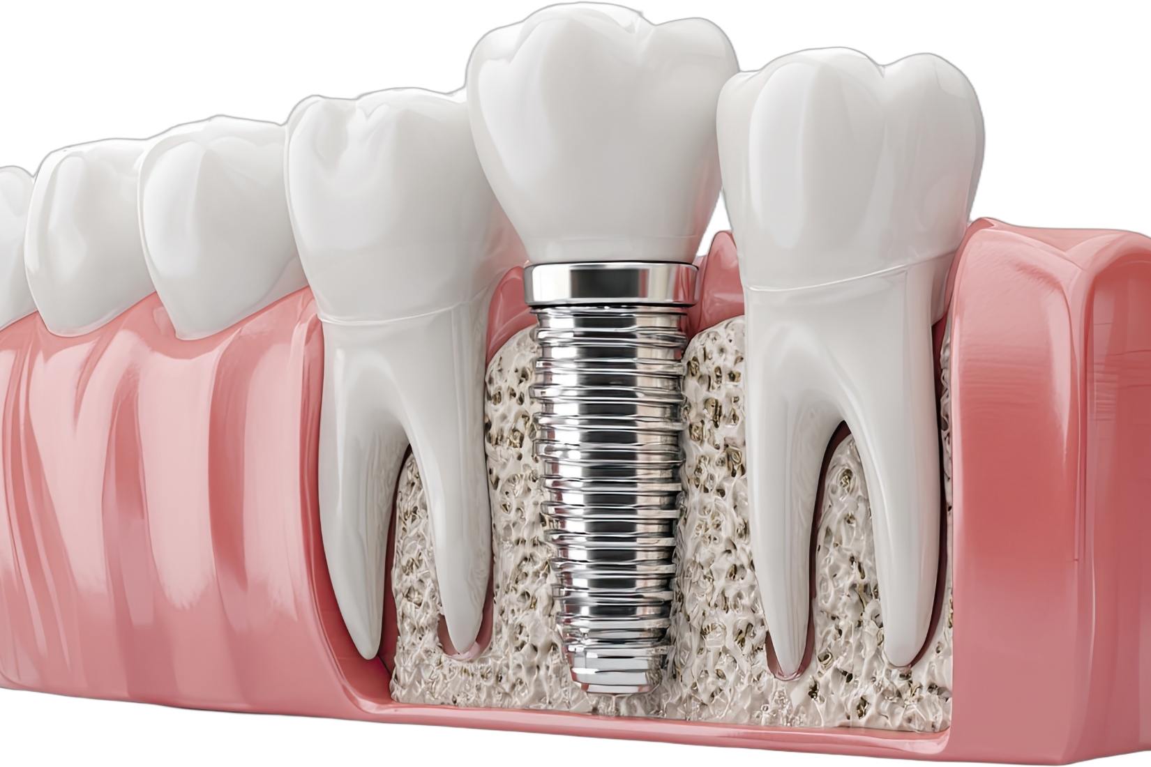 Tek diş eksikliğinde implant ve köprü uygulamasını karşılaştıran bilgilendirici dental şema.