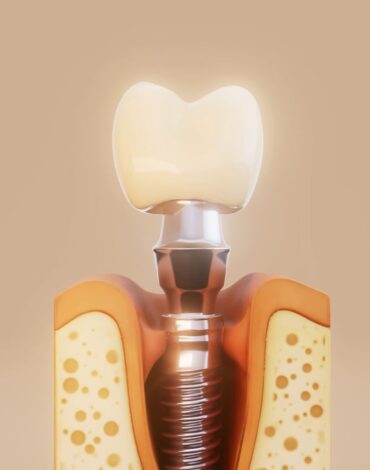 Dental implantın yerleştirilmesi ve üst yapı aşamalarını gösteren aşamalı implant tedavi süreci görseli.