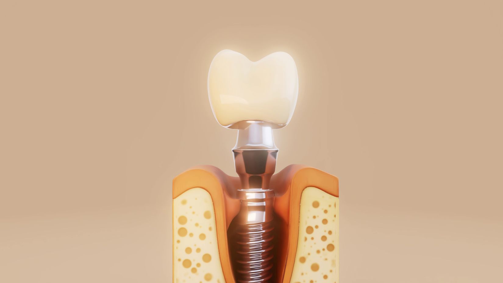 Dental implantın yerleştirilmesi ve üst yapı aşamalarını gösteren aşamalı implant tedavi süreci görseli.
