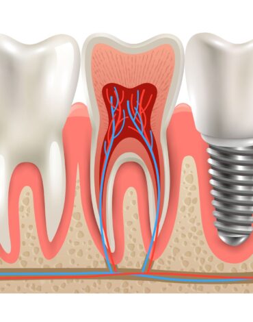 Tüm diş eksikliğinde uygulanan full mouth implant sistemini ve sabit protez yapısını gösteren dental görsel.
