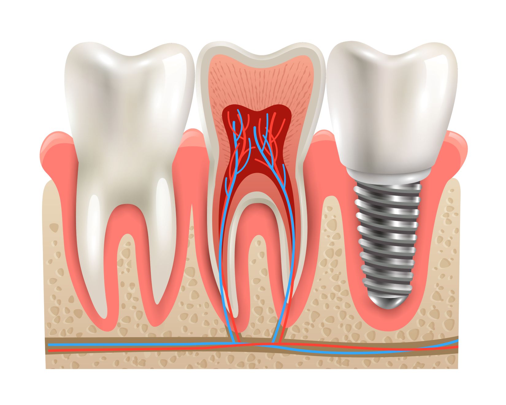 Tüm diş eksikliğinde uygulanan full mouth implant sistemini ve sabit protez yapısını gösteren dental görsel.