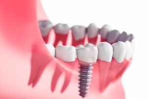 Çene kemiğine yerleştirilen dental implant ve implant üstü protezi gösteren bilgilendirici dental görsel.