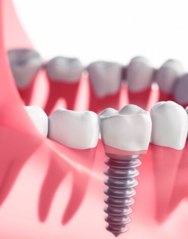 Çene kemiğine yerleştirilen dental implant ve implant üstü protezi gösteren bilgilendirici dental görsel.