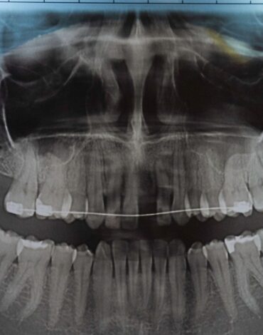 Çene kemiği içinde kalan gömülü dişin konumunu ve cerrahi değerlendirme sürecini gösteren dental görsel.