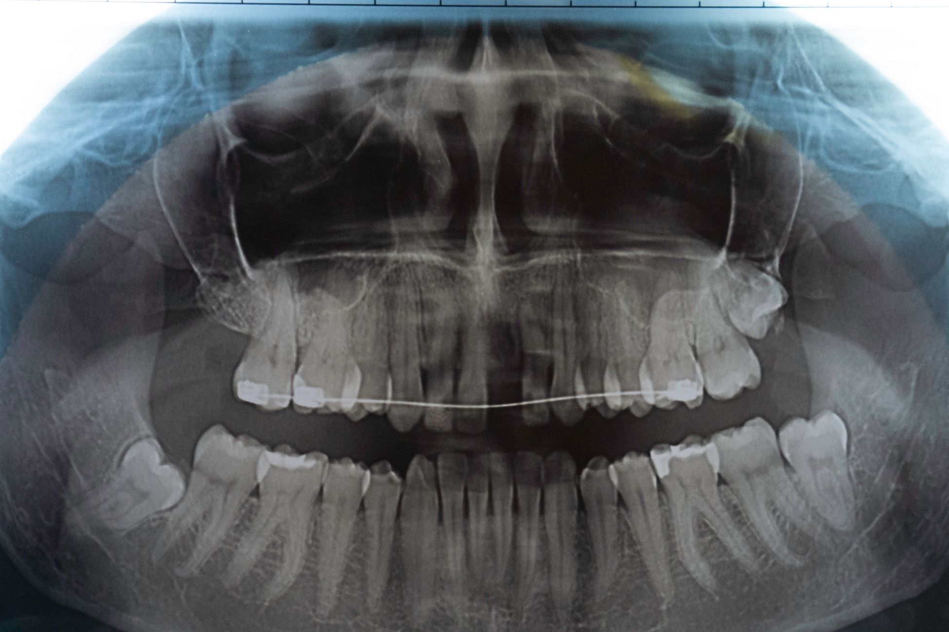 Çene kemiği içinde kalan gömülü dişin konumunu ve cerrahi değerlendirme sürecini gösteren dental görsel.
