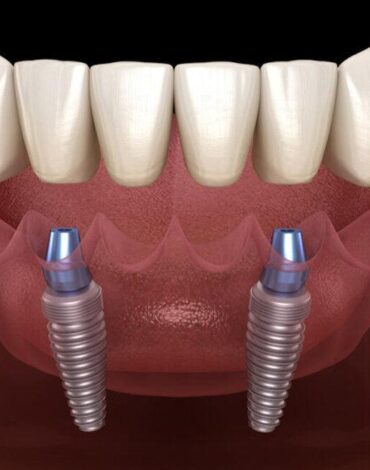 All-on-4 ve All-on-6 implant sistemlerinde çene kemiğine yerleştirilen implantları gösteren dental görsel.
