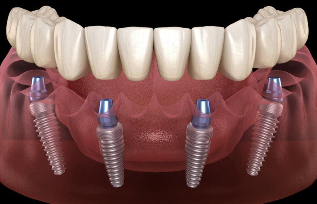 All-on-4 ve All-on-6 implant sistemlerinde çene kemiğine yerleştirilen implantları gösteren dental görsel.