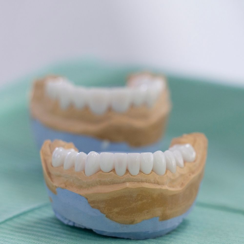 Konya porselen diş restorasyonu sonrası doğal görünümlü ön diş kaplama