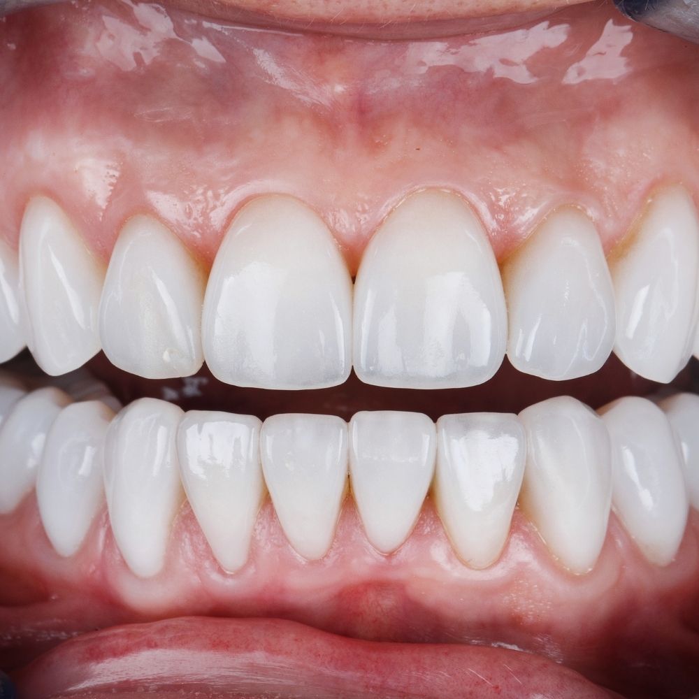 Konya bonding uygulaması sırasında kompozit materyal ile diş şekillendirme