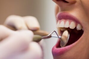 Porselen diş kaplamasının diş üzerine yerleştirilmiş halini ve doğal görünümünü gösteren dental görsel.