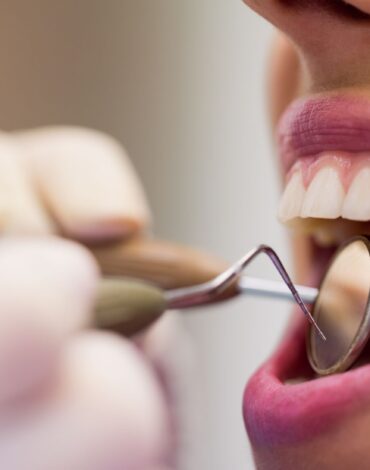 Porselen diş kaplamasının diş üzerine yerleştirilmiş halini ve doğal görünümünü gösteren dental görsel.
