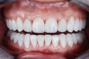 Ön diş estetiği değerlendirmesi, diş formu ve gülüş analizi sürecini gösteren profesyonel dental görsel.