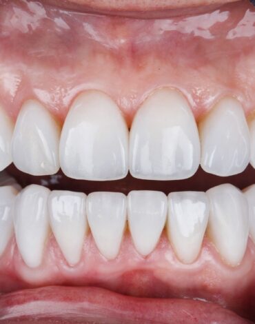 Ön diş estetiği değerlendirmesi, diş formu ve gülüş analizi sürecini gösteren profesyonel dental görsel.